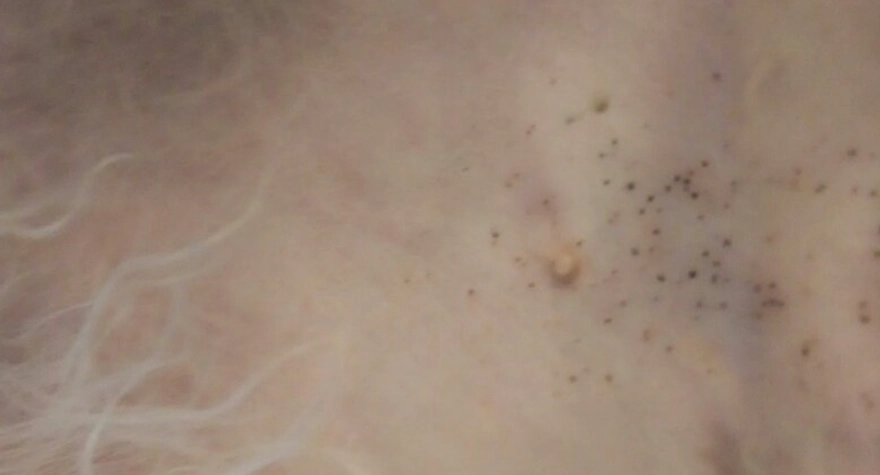 狗狗皮膚癌治療